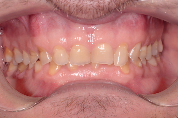 Restauración dental - Antes