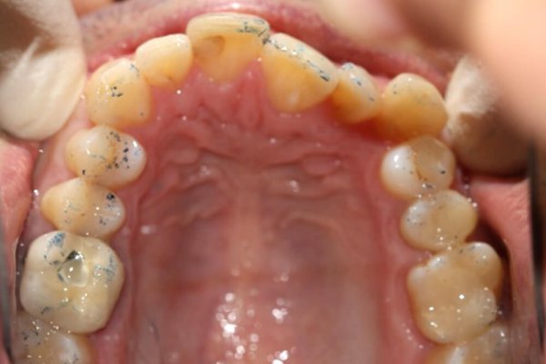 Ortodoncia - Antes