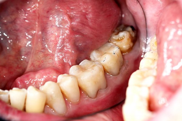 Odontología Conservadora - Después