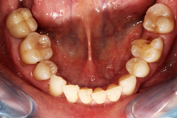 Odontología Conservadora - Antes