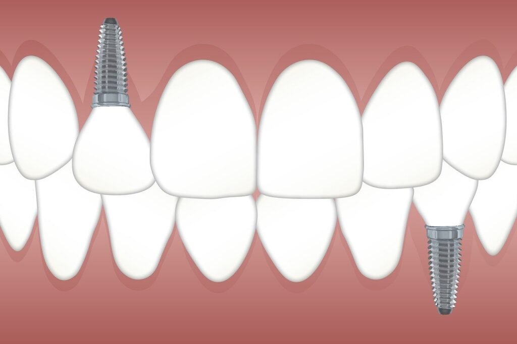 teeth, implant, orthodontics, jaw, dentist, dental, dentistry, clinic, operation, health, hygiene, white, toothache, tooth, surgery, office, implants, implant, implant, implant, implant, dentist, dentist, dental, dental, dental, dental, dental, tooth, tooth, implants