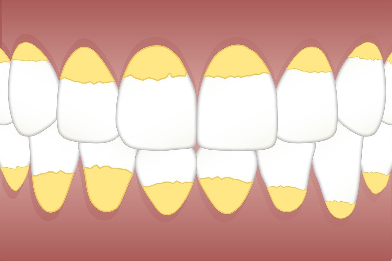 dental, calculus, teeth, tartar, white, spot, tongue, patches, dentist, hygiene, dentistry, tooth, mouth, care, oral, healthcare, clinic, cleanliness, medicine, clean, health, dental, teeth, teeth, tartar, tartar, tartar, tartar, tartar, dentist, dentist, tooth, mouth