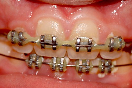 Braces on teeth