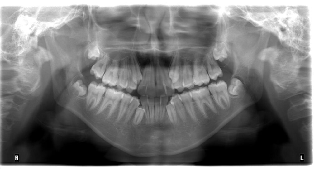 Orthopantomogram of severe dental crowding