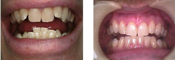 File:before and after photos following orthodontic treatment teeth braces.jpg