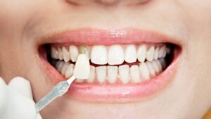 Cuando usar carillas dentales 1