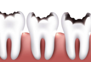 Tratamiento de caries dental