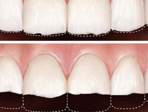 Persona observando desgaste dental en dientes delanteros
