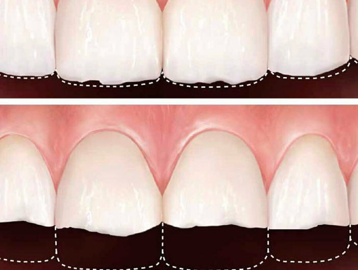 Persona observando desgaste dental en dientes delanteros
