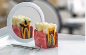 muela con pérdida de un empaste dental dejando visible la cavidad