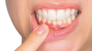 Paciente observando encías retraídas y raíz dental parcialmente expuesta